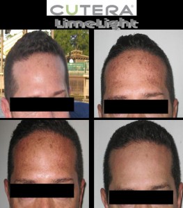 Cutera LimeLight Facial Skin Rejuvenation Treatment, Miami Beach Florida No Lines Med Spa